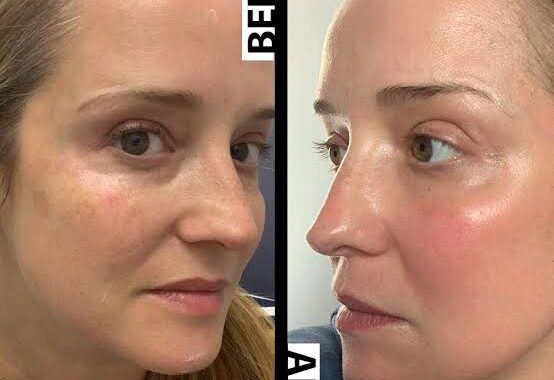 Laser Skin Resurfacing for Skin Renewal: Everything You Need to Know